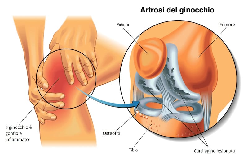 Artrosi? Scopri come l’acido ialuronico può migliorare la tua vita